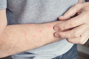 Mosquito Bite and a Spider Bite